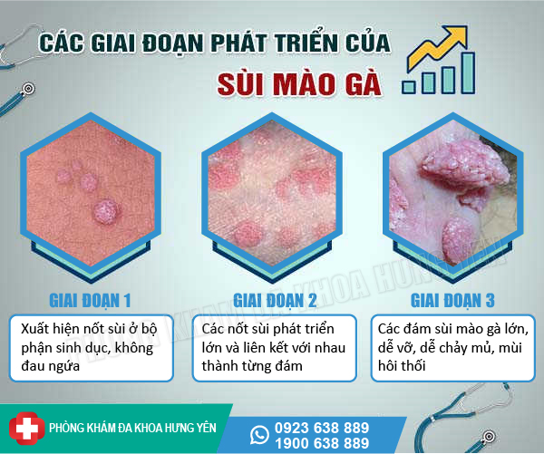 sùi mào gà có mấy giai đoạn