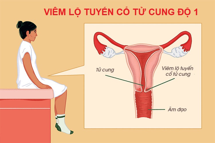 viêm lộ tuyến cổ tử cung độ 1