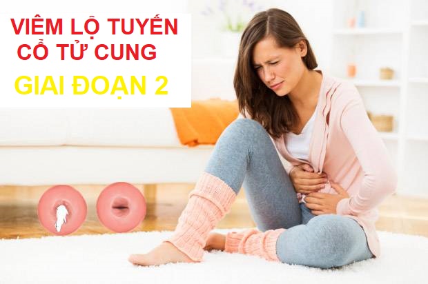 viêm lộ tuyến cổ tử cung giai đoạn 2